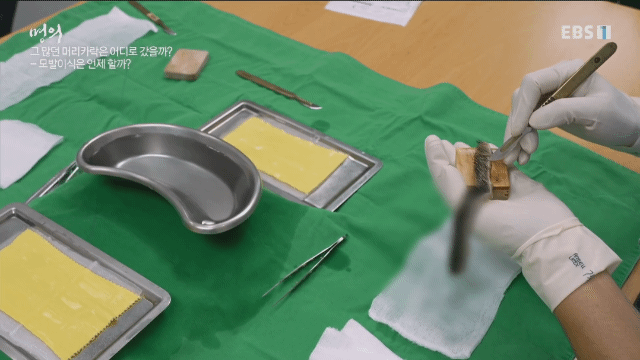 (주의) 실제 모발이식 장면.gif | 인스티즈