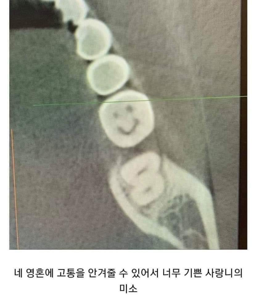 사랑니의 미소 | 인스티즈