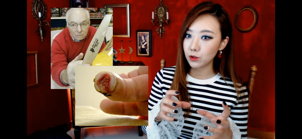 돼지 방광으로 잘린손가락 재생사례(손가락사진 주의) | 인스티즈