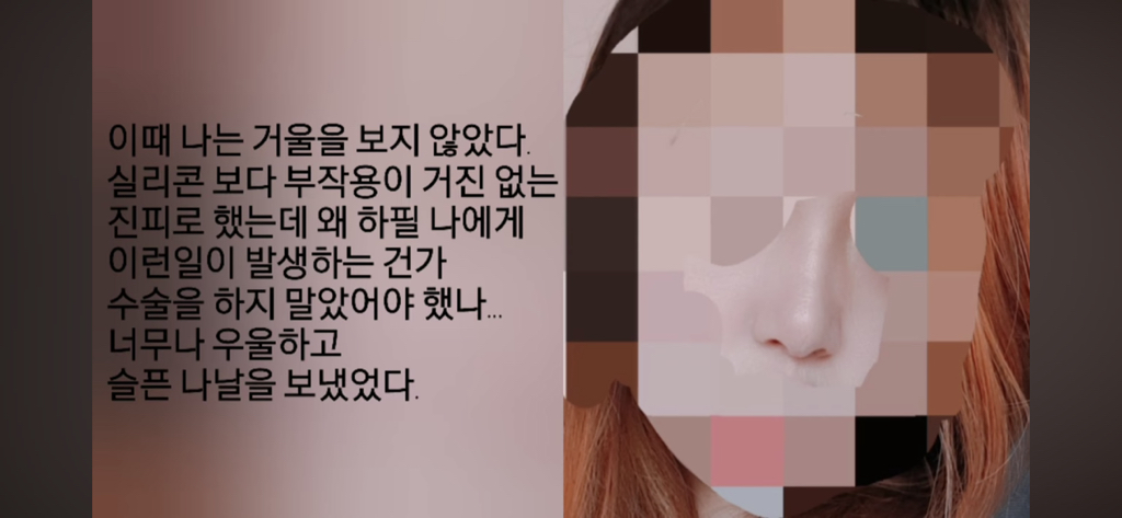 코수술 부작용으로 인한 코끝 꺼짐 + 자가진피 코수술 후기 | 인스티즈