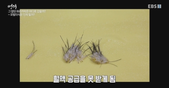 (주의) 실제 모발이식 장면.gif | 인스티즈
