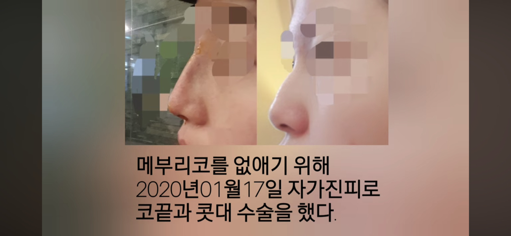 코수술 부작용으로 인한 코끝 꺼짐 + 자가진피 코수술 후기 | 인스티즈