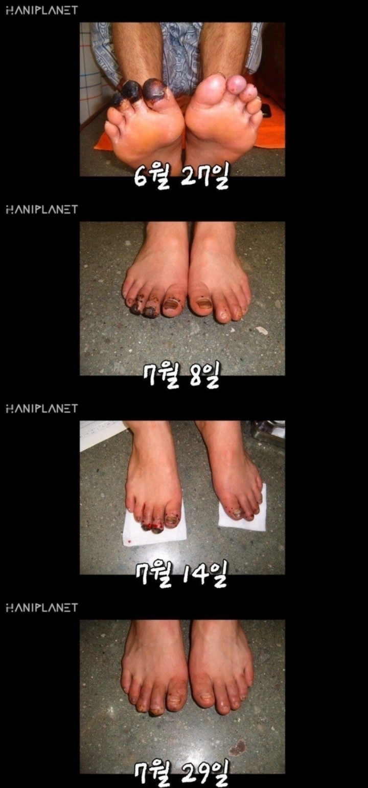 한의원 동상 치료 논란 본인 인터뷰.jpg | 인스티즈