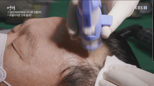 (주의) 실제 모발이식 장면.gif | 인스티즈