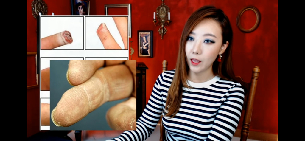 돼지 방광으로 잘린손가락 재생사례(손가락사진 주의) | 인스티즈