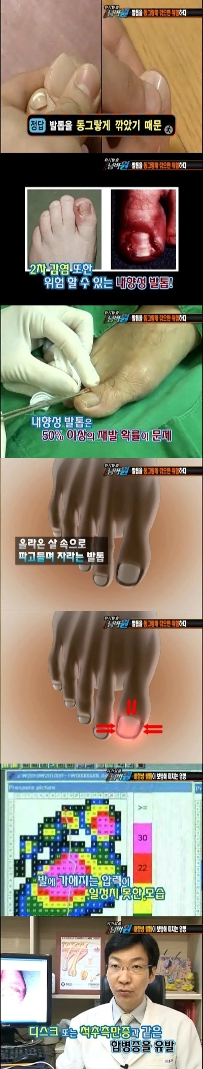 발톱 동그랗게 깎으면 안되는 이유 | 인스티즈
