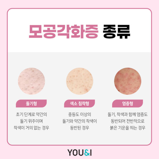 모공각화증에 효과있는 방법이나 꿀템 추천하고 가는 글 | 인스티즈