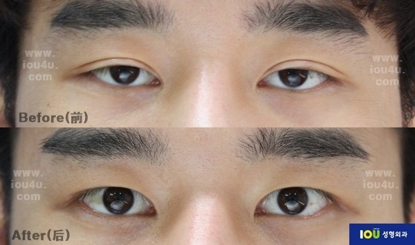 모르는 사람이 많다는 쌍커풀 푸는 수술 | 인스티즈