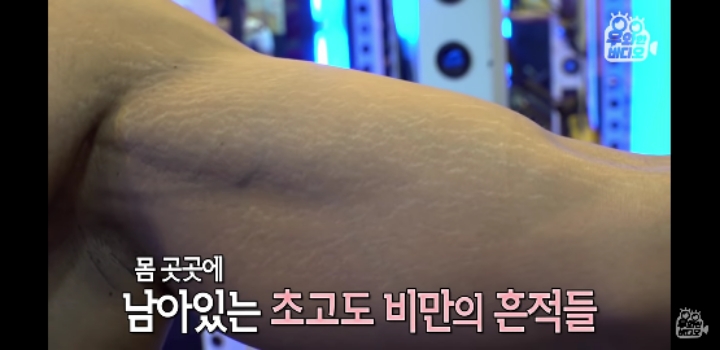 150키로 초고도비만 남자 5년만에 | 인스티즈