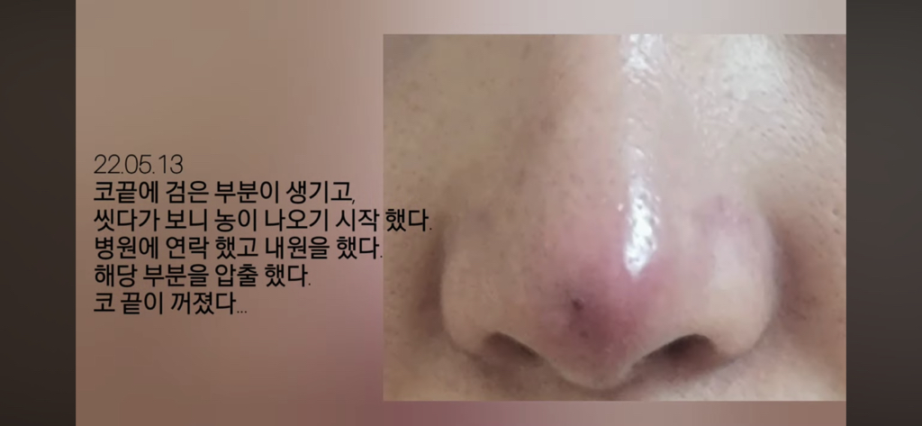 코수술 부작용으로 인한 코끝 꺼짐 + 자가진피 코수술 후기 | 인스티즈