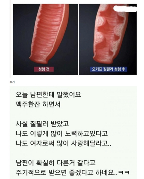 질 필러 후기 | 인스티즈