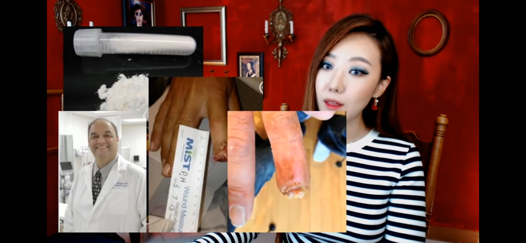 돼지 방광으로 잘린손가락 재생사례(손가락사진 주의) | 인스티즈