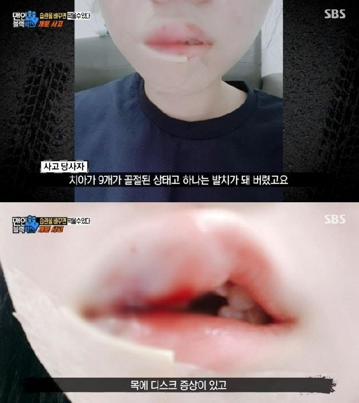 문열다가 치아 9개 날라간 사고영상 | 인스티즈