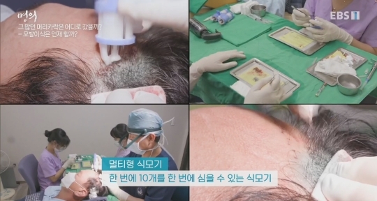 (주의) 실제 모발이식 장면.gif | 인스티즈