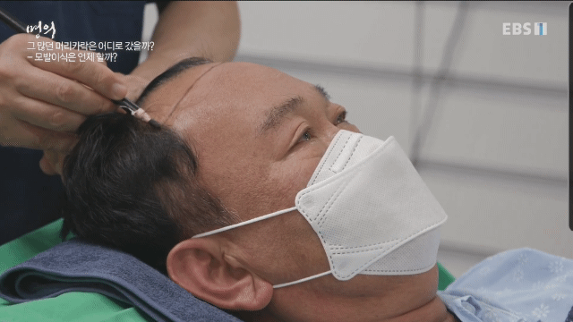 (주의) 실제 모발이식 장면.gif | 인스티즈