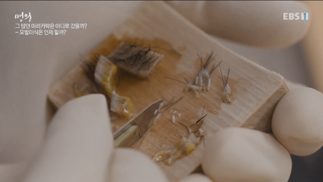 (주의) 실제 모발이식 장면.gif | 인스티즈