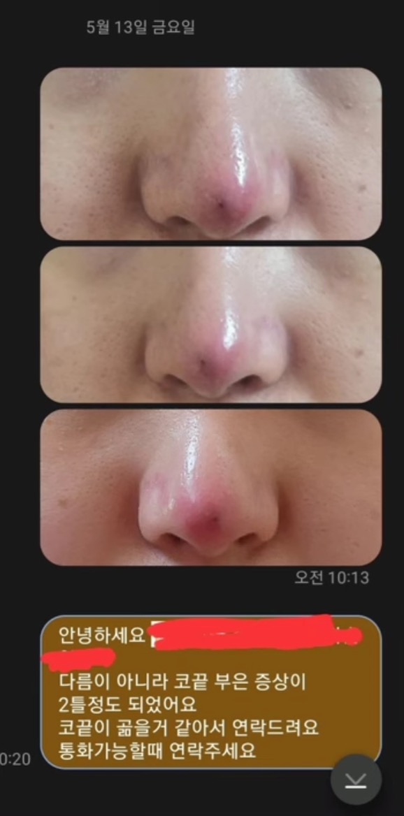 코수술 부작용으로 인한 코끝 꺼짐 + 자가진피 코수술 후기 | 인스티즈