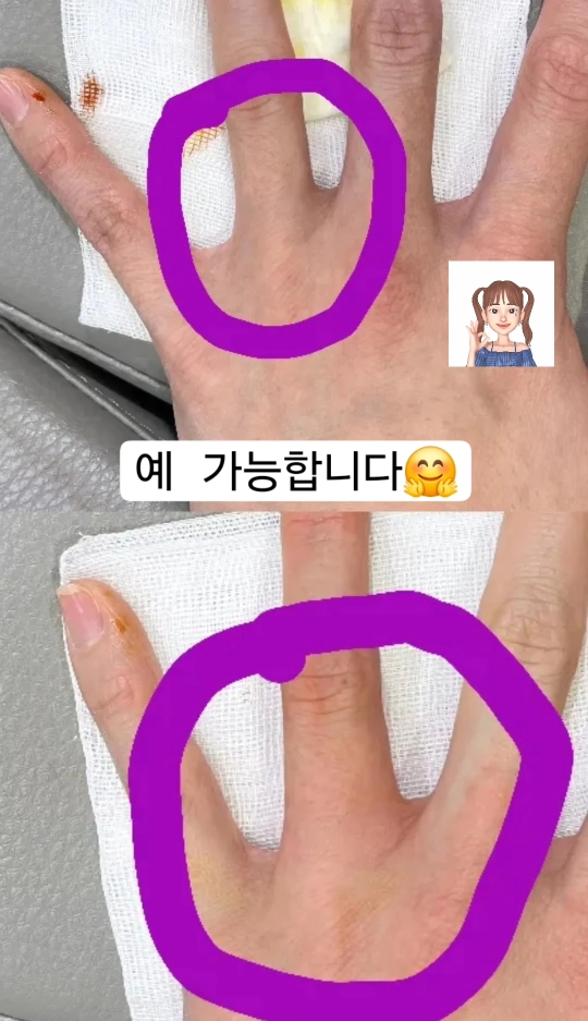 반지가 헐거워서 손가락에 필러맞은 사람,, | 인스티즈