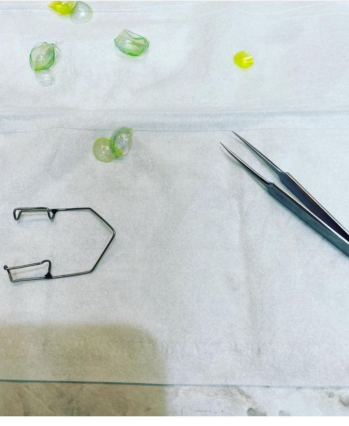 (혐오주의) 눈 한쪽에서 콘택트 렌즈 23개 돌아다녔던 사례...gif | 인스티즈