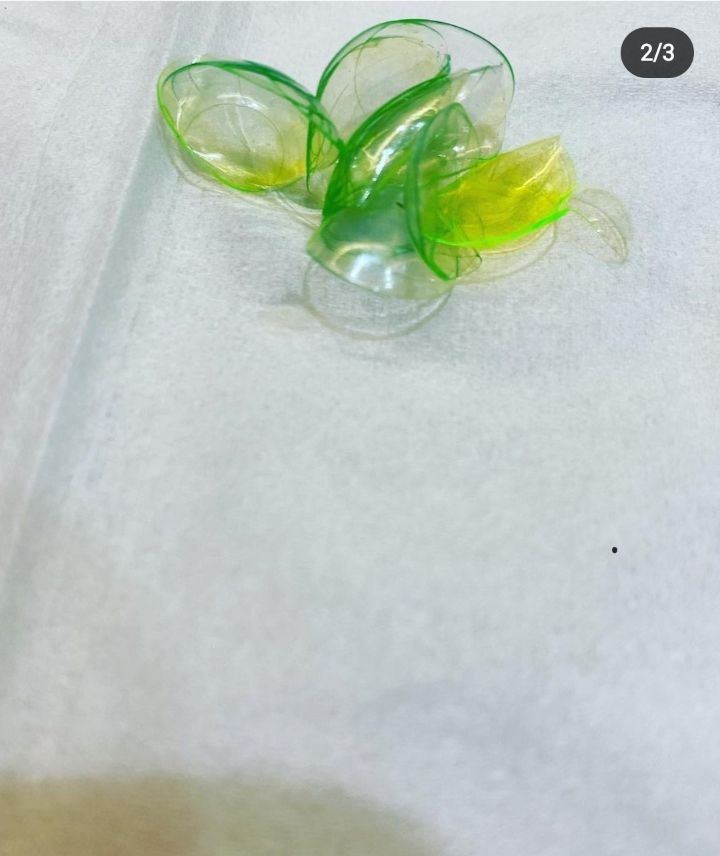 (혐오주의) 눈 한쪽에서 콘택트 렌즈 23개 돌아다녔던 사례...gif | 인스티즈