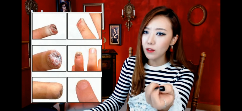 돼지 방광으로 잘린손가락 재생사례(손가락사진 주의) | 인스티즈