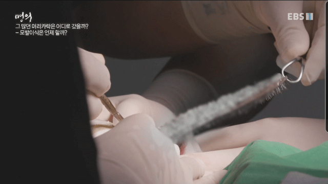 (주의) 실제 모발이식 장면.gif | 인스티즈
