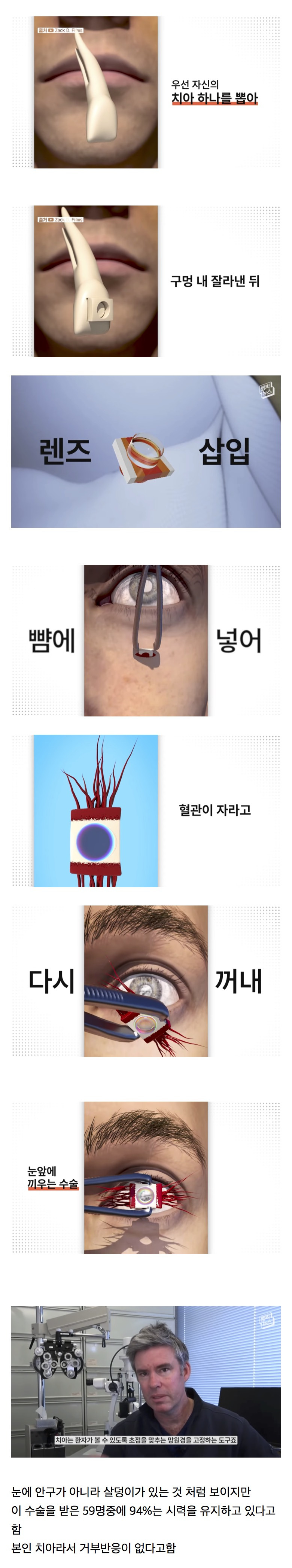 시각장애인의 눈에 치아를 넣어 시력을 회복하는 수술.jpg | 인스티즈