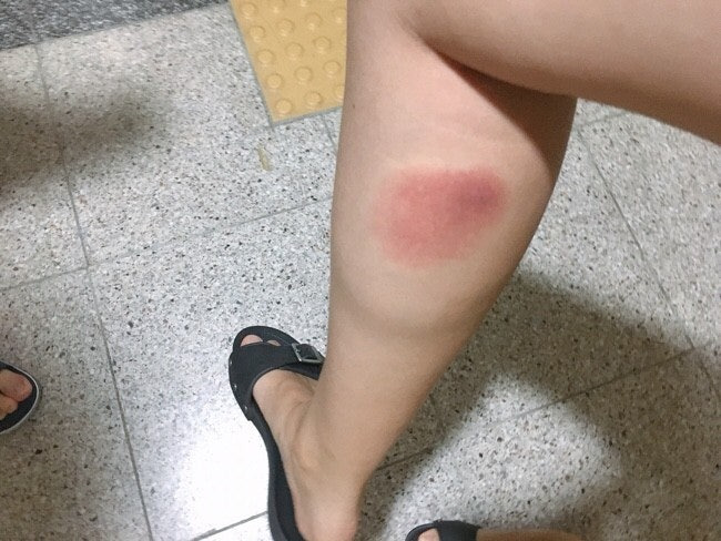 모기 물리면 개 크게 물리는 사람들 | 인스티즈