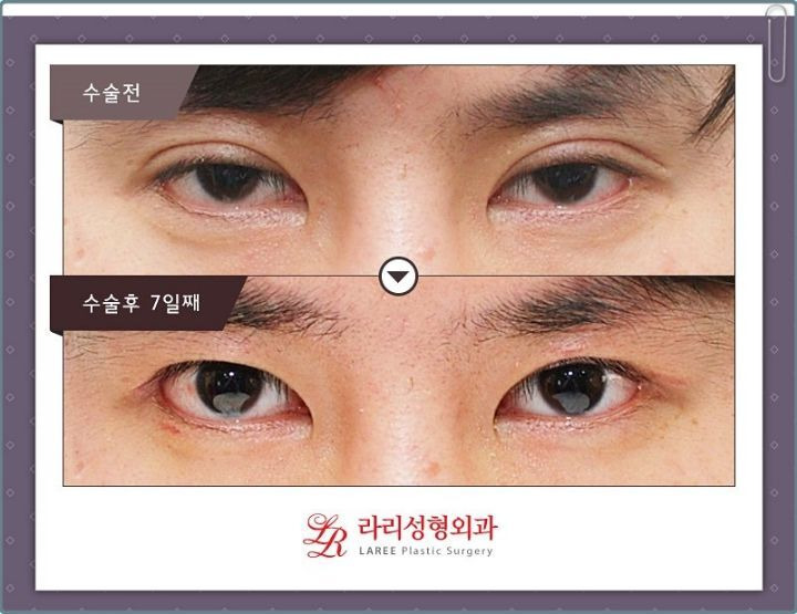 모르는 사람이 많다는 쌍커풀 푸는 수술 | 인스티즈