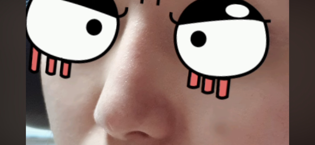 코수술 부작용으로 인한 코끝 꺼짐 + 자가진피 코수술 후기 | 인스티즈