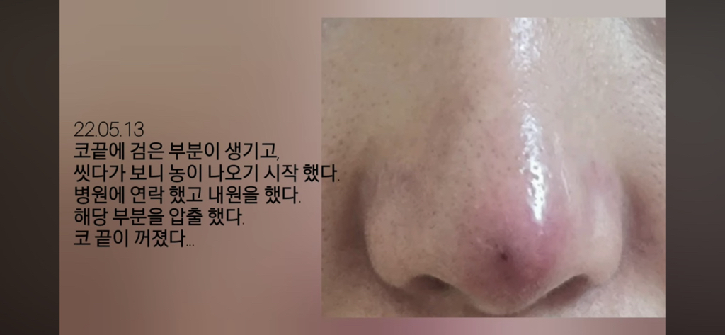 코수술 부작용으로 인한 코끝 꺼짐 + 자가진피 코수술 후기 | 인스티즈