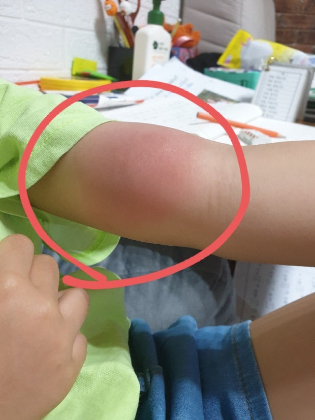 모기 물리면 개 크게 물리는 사람들 | 인스티즈