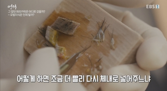 (주의) 실제 모발이식 장면.gif | 인스티즈