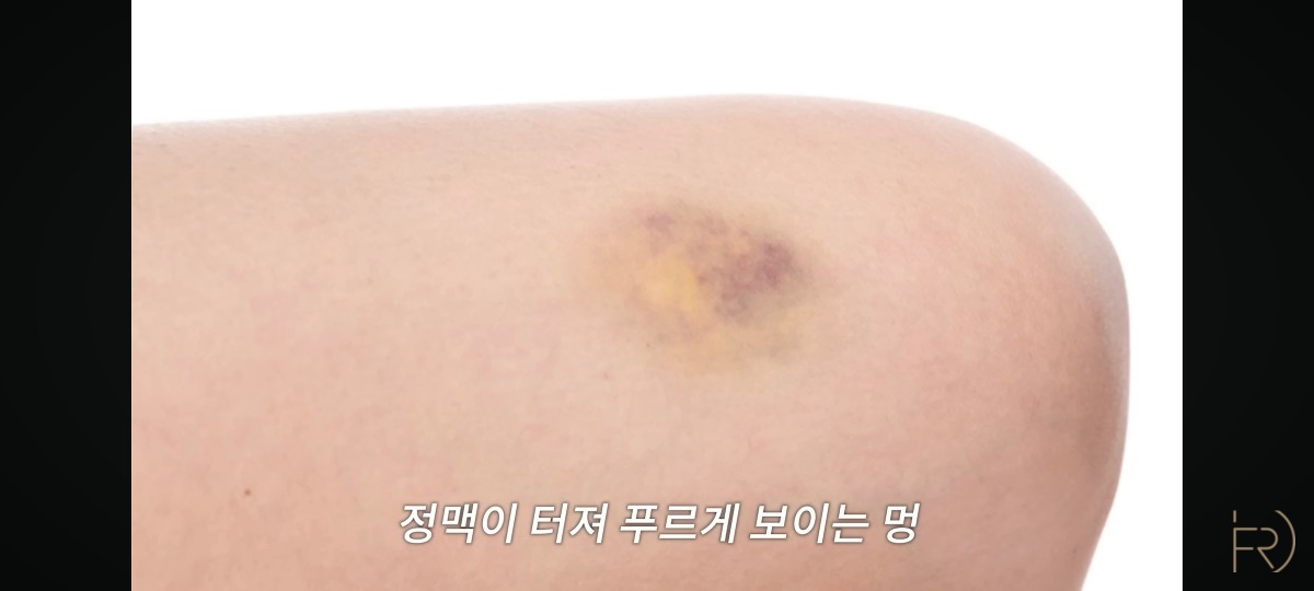 의사가 말하는 종아리 마사지(기계) 하지말아야하는 이유.jpg | 인스티즈