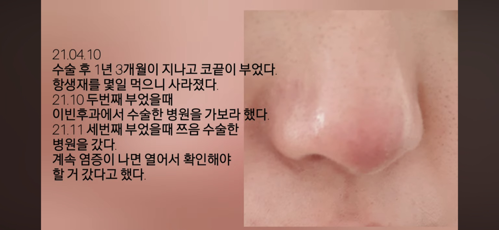 코수술 부작용으로 인한 코끝 꺼짐 + 자가진피 코수술 후기 | 인스티즈