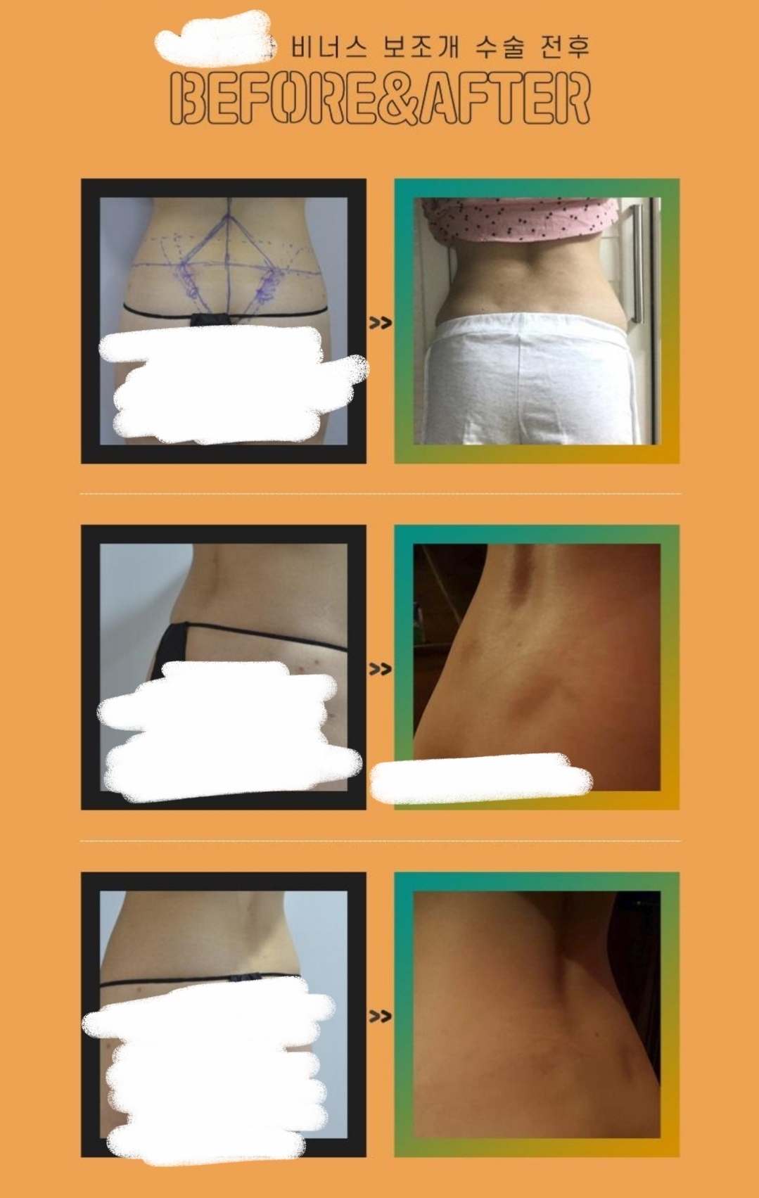 해외에서 유행하다가 우리나라에서도 시행하는 성형부위.jpg | 인스티즈