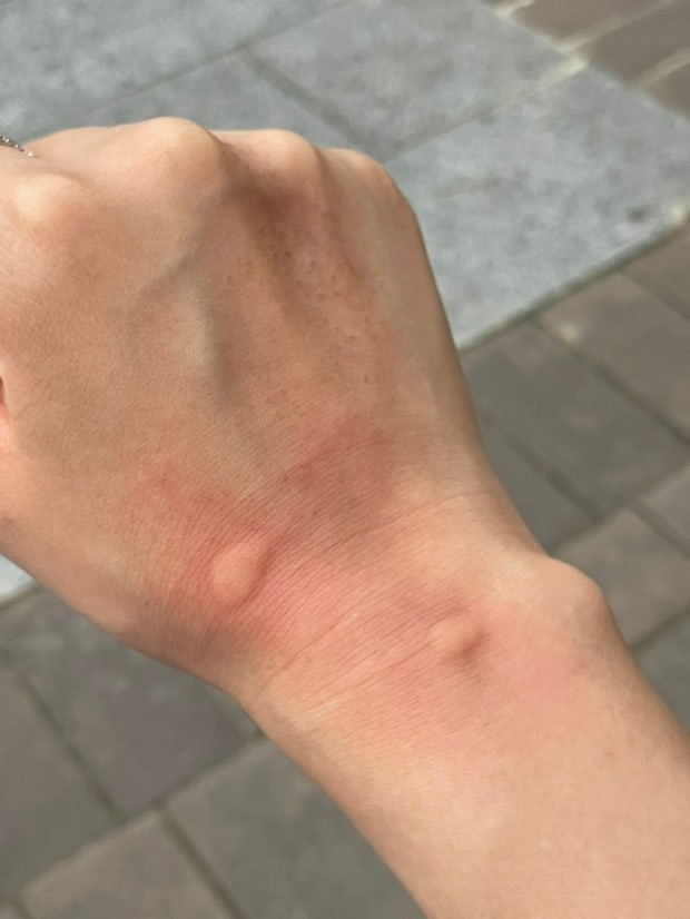 모기 물리면 개 크게 물리는 사람들 | 인스티즈