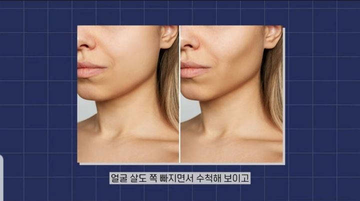 이게 머선129... 살뺄려고 당뇨병 치료제 복용하는 미국인들, 당뇨병 치료제 품귀로 약을 못구하는 환자들 | 인스티즈