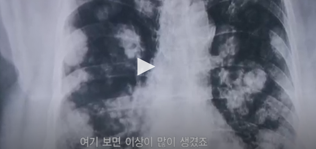 린 전자담배 이미지
