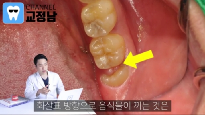 누운 사랑니를 반드시 뽑아야 하는이유.jpg | 인스티즈