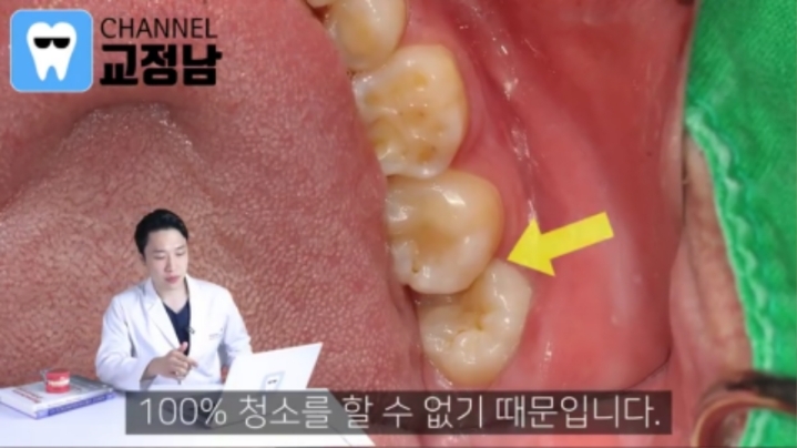 누운 사랑니를 반드시 뽑아야 하는이유.jpg | 인스티즈