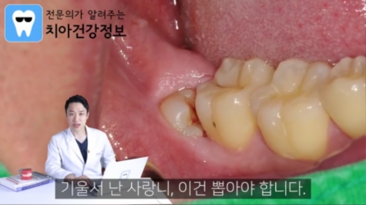 누운 사랑니를 반드시 뽑아야 하는이유.jpg | 인스티즈