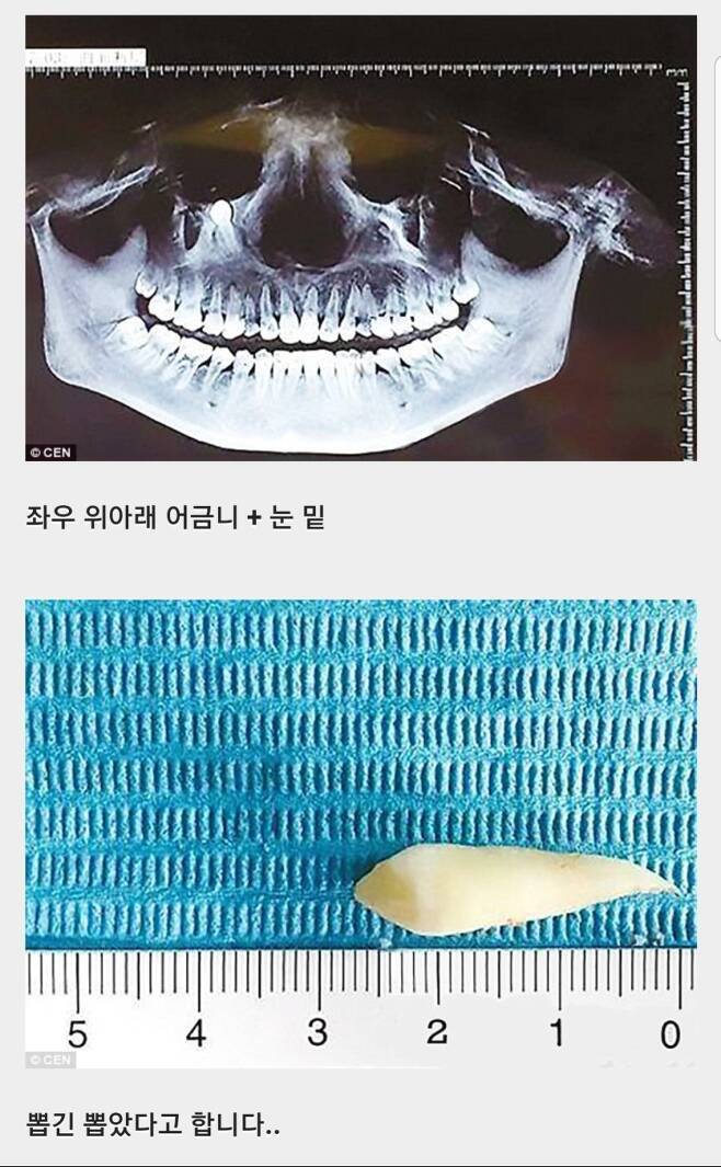 사랑니 레전드 | 인스티즈