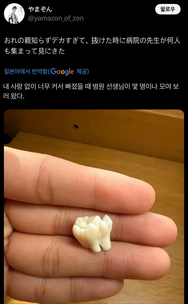 뺼때 의사선생님들이 구경했다는 사랑니 | 인스티즈