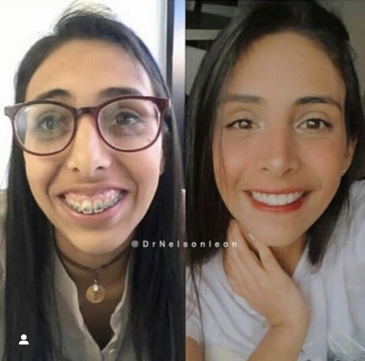 치아교정이 필요한 이유.JPG | 인스티즈