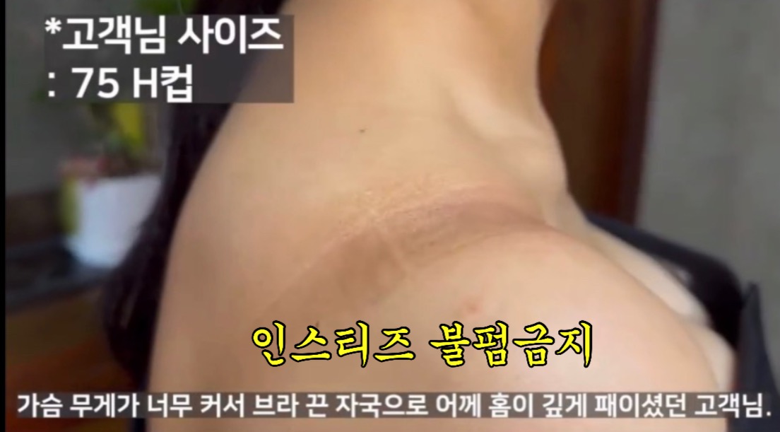 가슴 무게가 너무 크면 생기는 어깨 패임 | 인스티즈