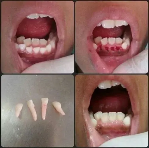 (사진주의) 유치가 안빠졌는데 영구치가 났어요 | 인스티즈