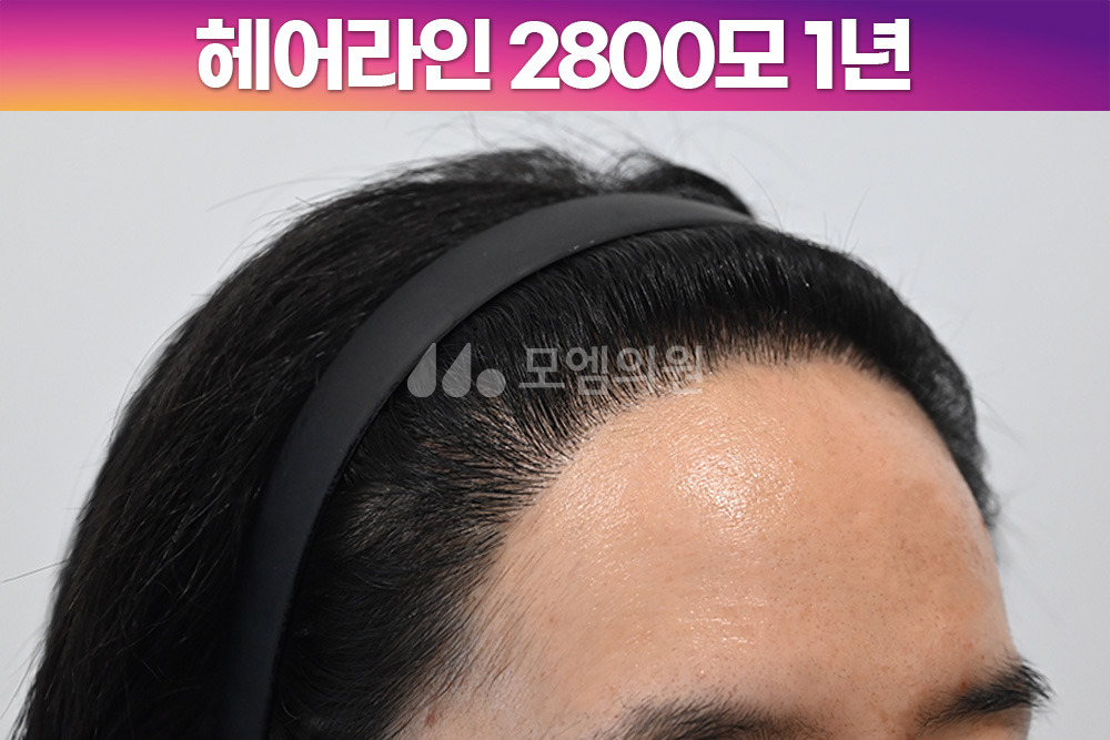 헤어라인 이미지