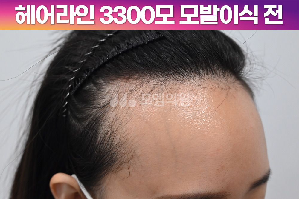 헤어라인 이미지