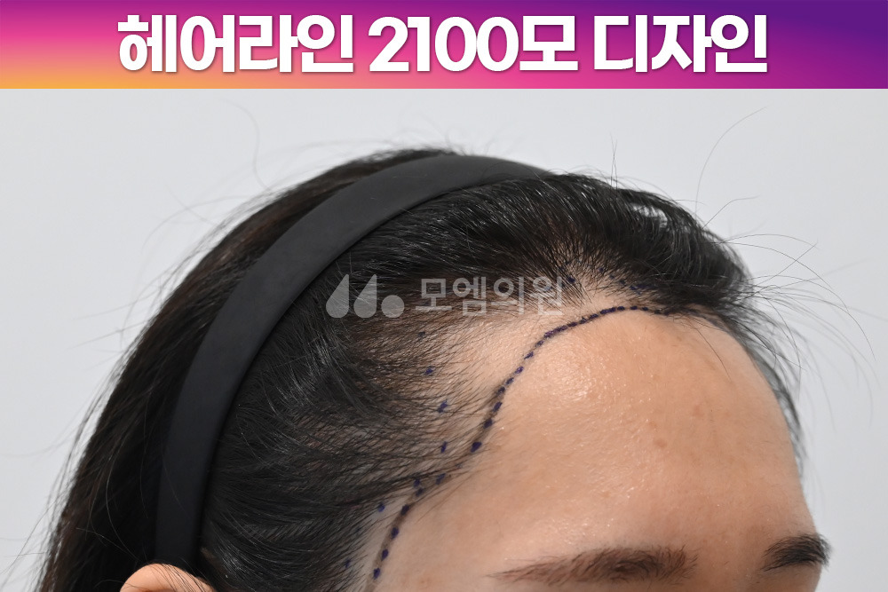 헤어라인 이미지